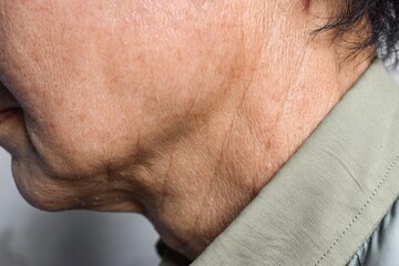 Aging skin folds or skin creases or wrinkles of Asian Chinese old man.