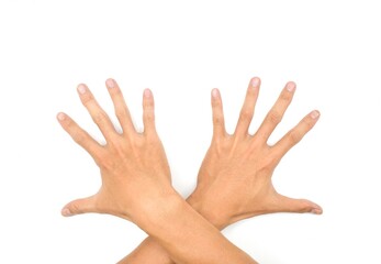 Spastic hand. Hand muscle spasticity.