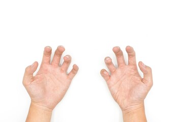 Volkmann contracture in Southeast Asian young man.