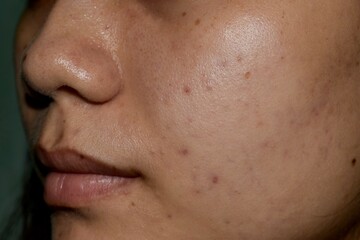 Acne, dark spots and scars on face