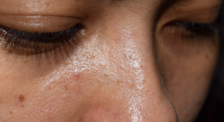 Whiteheads and pimples on oily face of Asian woman. - obrazy, fototapety, plakaty