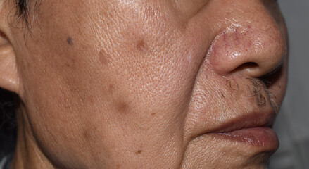 Fototapeta premium Small brown patches called age spots on face of Asian elder man. They are also called liver spots, senile lentigo, or sun spots.