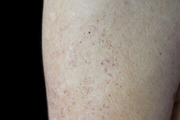 Fototapeta premium Age spots and white patches on the arm. They are brown, gray, or black spots and also called liver spots, senile lentigo, solar lentigines, or sun spots.