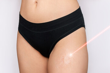 Laser scar removal. Cropped shot of a young woman with a burn scar on her thigh with a red laser beam aimed at this isolated on a gray background. Skin problem. Cosmetology, beauty