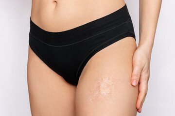 Cropped shot of a young woman with a burn scar on her thigh isolated on a gray background. Skin...