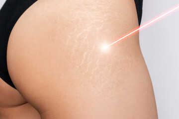 Laser removal of stretch marks. Cropped shot of a young woman with white stretch marks from a weight loss or weight gain on her thigh with a red laser beam aimed at them. Cosmetology, beauty