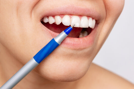 Cropped shot of a young woman pointing to white spots on the tooth enamel with a pen. Oral hygiene, dental health care. Dentistry, demineralization of teeth, enamel hypoplasia, fluorosis