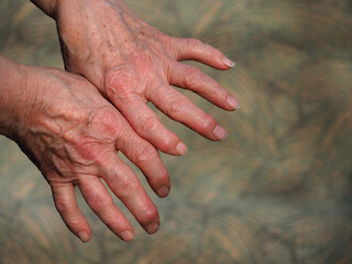 Close-up of an elderly woman's hands. Hands affected by osteochondrosis or arthritis of the joints...