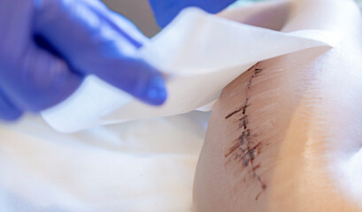 The doctor applies a patch to the scar after surgery on the child's leg. Antibacterial patch. - obrazy, fototapety, plakaty