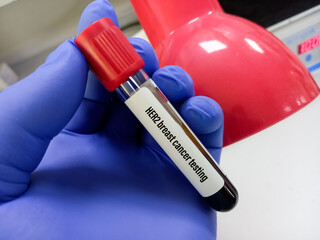 Blood sample for Her-2 breast cancer testing, human epidermal growth factor receptor 2(HER2), ERBB2...