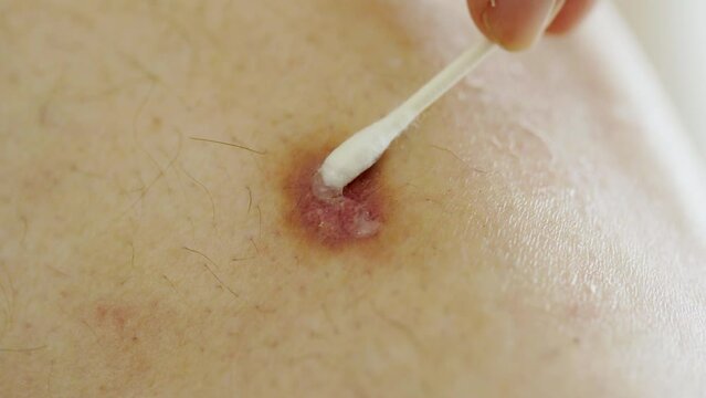 putting Vaseline on a skin cancer spot on a mans leg