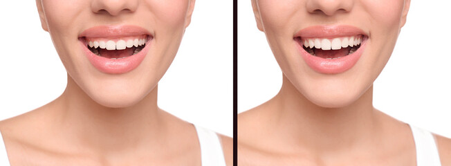 Young woman before and after gingivoplasty procedure on white background, closeup. Banner design