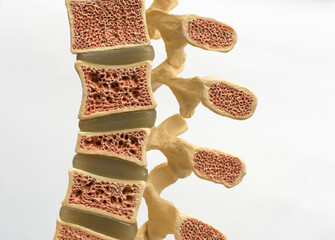 Model of the human spine on a white background, which shows various defects in bones and vertebrae. From top to bottom: normal vertebral bone, osteoporotic bone, wedge fracture, compression fracture. - obrazy, fototapety, plakaty
