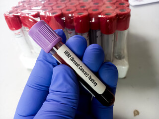 Blood sample for Her-2 breast cancer testing, human epidermal growth factor receptor 2(HER2), ERBB2 Amplification.
