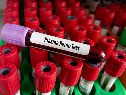 Blood sample for Direct renin test to diagnose adrenal gland disorder, CKD, renin blood test, plasma renin activity.