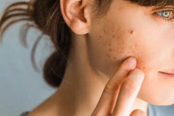 Woman with red cheeks- diathesis or allergy symptoms. Redness and peeling of the skin on the face....