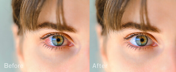 Red eye before and after treatment. Tired eyes and contact lenses. Close up. Dry eye before and after the use of eye drop.