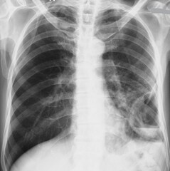 chest x-ray image of  lung abscess
