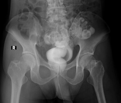 X-ray image of rectovesical fistula A barium enema contrast study reveals contrasts on the rectum and bladder.