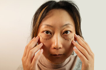 Asian Woman With Under Eye Bag. Puffy Eye Of Girl Showing Eyes Bags. Before And After Cosmetic Operation. 