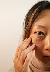 Asian Woman With Under Eye Bag. Puffy Eye Of Girl Showing Eyes Bags. Before And After Cosmetic Operation. 