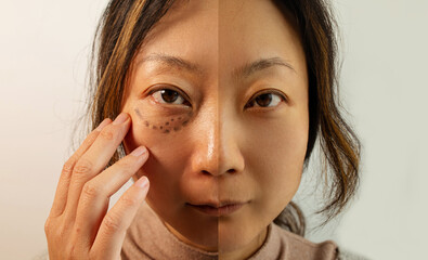 Asian Woman With Under Eye Bag. Puffy Eye Of Girl Showing Eyes Bags. Before And After Cosmetic...