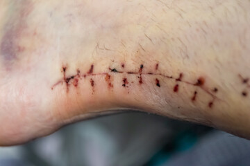 Wound suture after Achilles tendon rupture operation is treated and checked by doctor in the hospital showing stitches and operation transection with effusion of blood at European man foot 