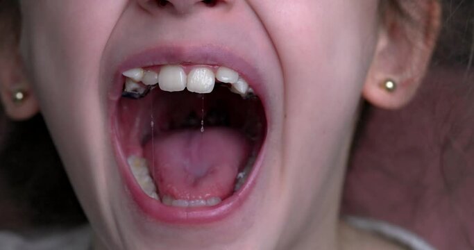 A young girl smiles and shows her crooked teeth. Mouth close-up.