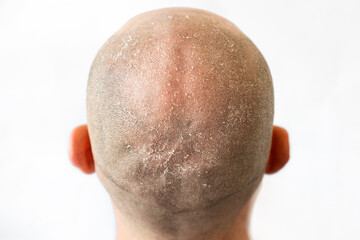 Male bald flaky head with dandruff close-up, back view. White background. The concept of psoriasis...
