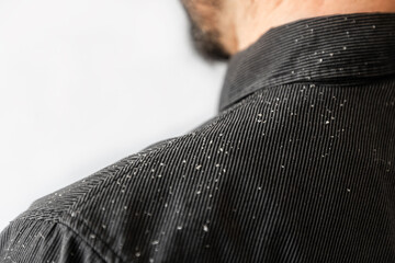 A bearded man in a black shirt, a close up view of the shoulder covered with dandruff. Copy space....