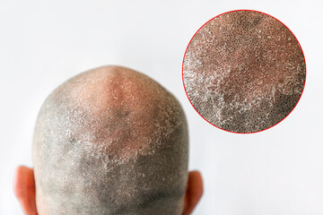 Man's bald flaky head with dandruff close-up, back view. White background with zoomed circle of...