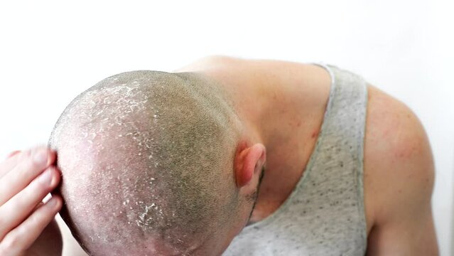 A man touches his bald head covered with seborrheic dermatitis and dandruff with his hand. The concept of skin problems and alopecia.
