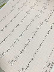 健康診断 不整脈 心房細動