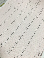健康診断 不整脈 心房細動