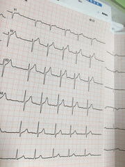 Naklejka premium 健康診断 不整脈 心房細動