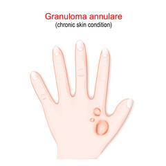 Obraz premium Granuloma annulare. Chronic skin condition.