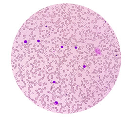 Acute lymphoblastic leukemia or Acute leukemia under microscopic examination in medical laboratory