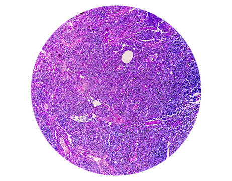 Photomicrograph Of Chronic Granulomatous Inflammation (CGI) Of Tuberculosis. CGI-TB. Epithelioid Histiocytes.