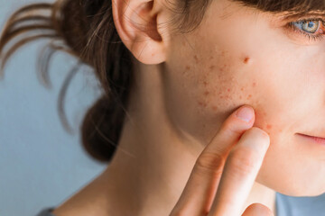 Beautiful girl with acne problem on her face skin, clean blurred background, closeup. Acne skin because of sebaceous gland production disorders.