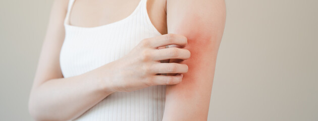 Fototapeta na wymiar Sensitive skin allergic concept, Woman itching on her arm have a red rash from allergy symptom and from scratching.