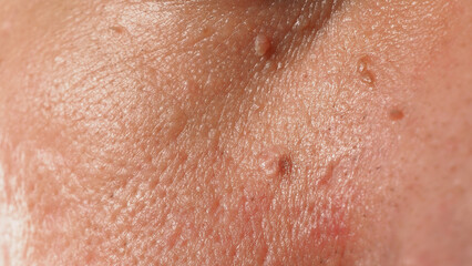 Wart skin removal. Macro shot of warts near eye on face. Papilloma on skin around eye nose and neck. Birthmark Papilla or mole on skin. small hard. benign growth on the skin caused by virus. Skincare