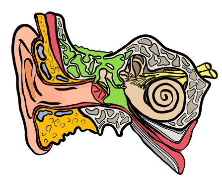Ohr Abbildung mit Mastoiditis, Entz&uuml;ndung des Felsenbeins
