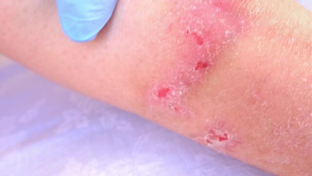 doctor treats large healing wound from on lower leg with scars of adult female patient, redness, scarring of skin, concept of medical care, health care, human tissue regeneration, scald on women feet