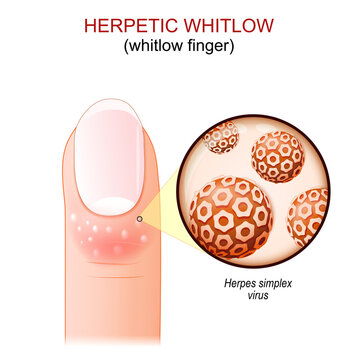 Herpetic whitlow. whitlow finger.