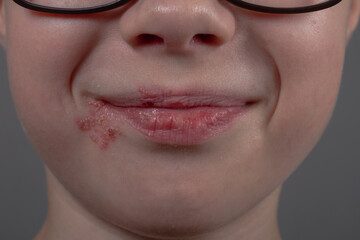 Herpes rash on the lips and face of a teenage boy