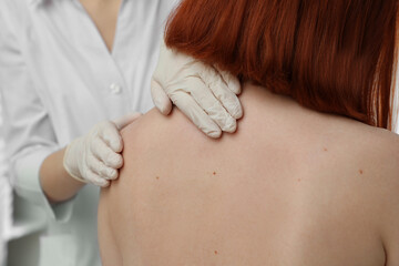 Dermatologist examining patient's birthmark in clinic, closeup view