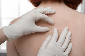 Dermatologist examining patient's birthmark in clinic, closeup view