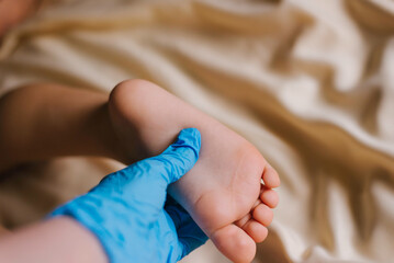 Doctor in blue gloves examines children's feet for the presence of diseases, fungus, flat feet.