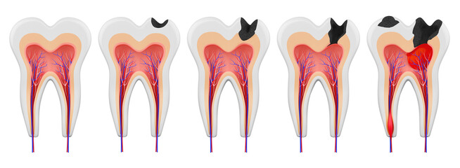 Stages of caries development in a human molar. Healthy tooth. Dental diseases of the teeth: enamel, dentin, deep caries, pulpitis, periodontitis. 3d illustration
