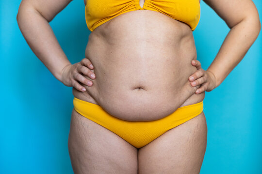 Keep hands on woman flabby sagging belly closeup, fat hips, obesity and cellulite. Naked overweight plus size girl on blue background in yellow underwear. Concept of dieting and lose weight.